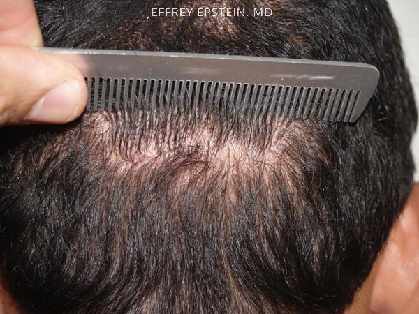 Hair Transplants for Men Before and after in Miami, FL, Paciente 39778