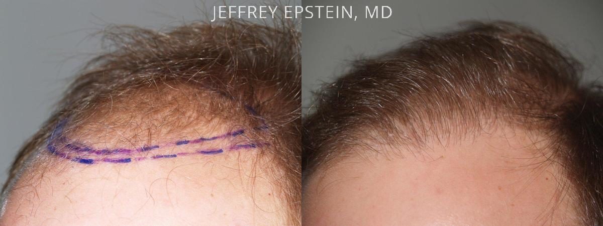 Hair Transplants for Men Before and after in Miami, FL, Paciente 39786
