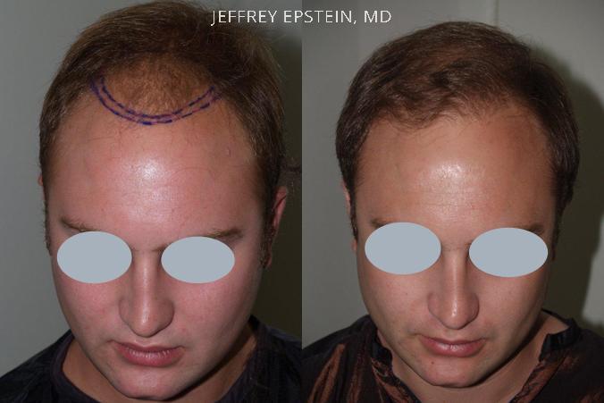 Hair Transplants for Men Before and after in Miami, FL, Paciente 39786