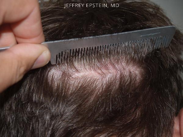 Hair Transplants for Men Before and after in Miami, FL, Paciente 39807