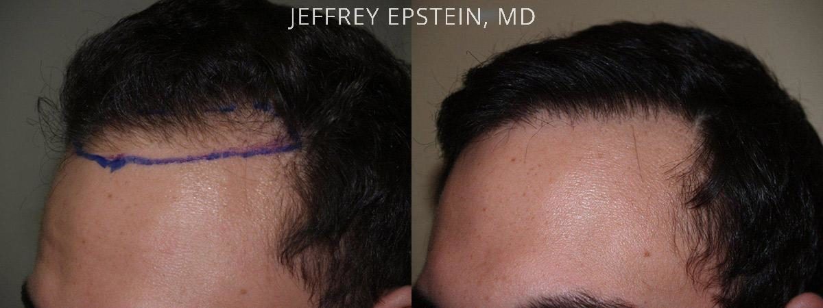 Hair Transplants for Men Before and after in Miami, FL, Paciente 39813