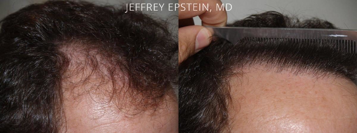 Hair Transplants for Men Before and after in Miami, FL, Paciente 39816