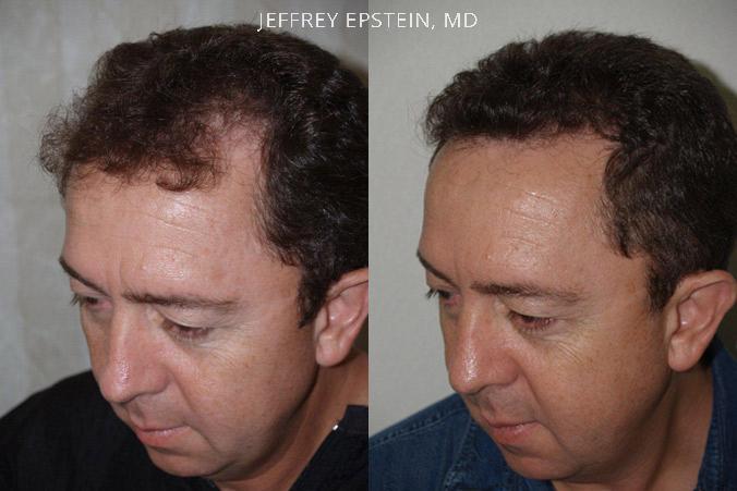 Hair Transplants for Men Before and after in Miami, FL, Paciente 39816