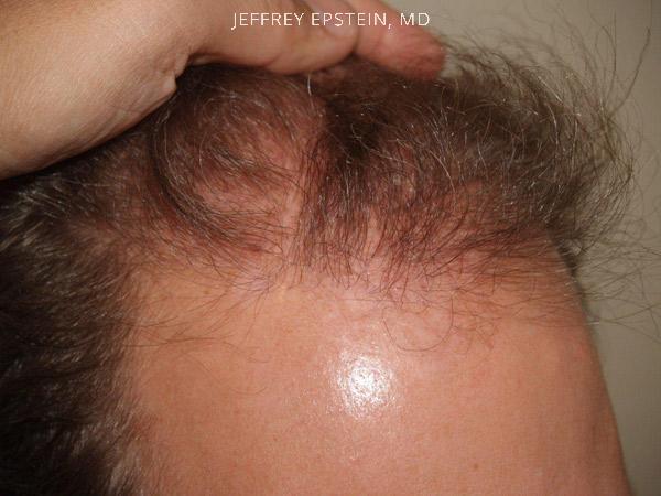 Hair Transplants for Men Before and after in Miami, FL, Paciente 39823