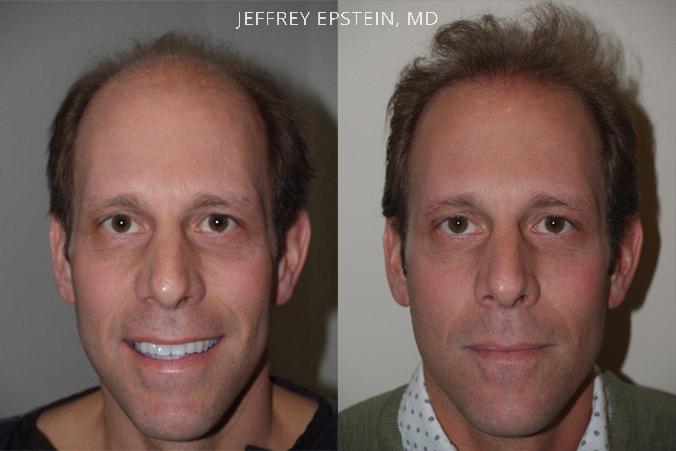 Hair Transplants for Men Before and after in Miami, FL, Paciente 39823