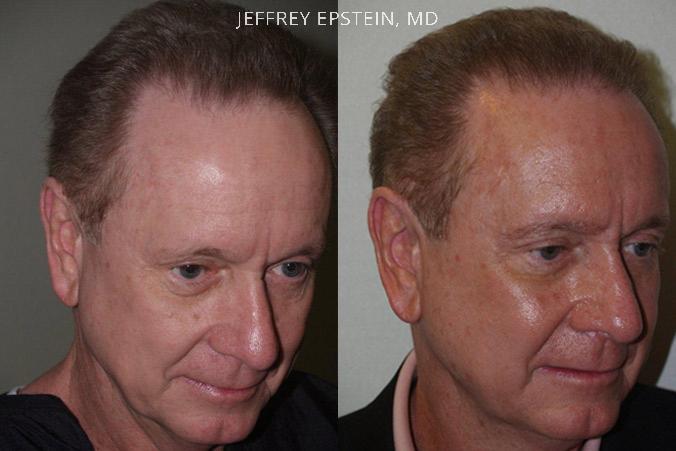 Hair Transplants for Men Before and after in Miami, FL, Paciente 39833