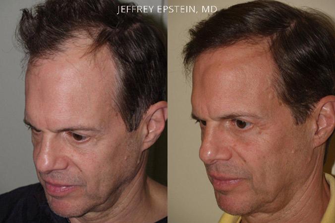 Hair Transplants for Men Before and after in Miami, FL, Paciente 39839