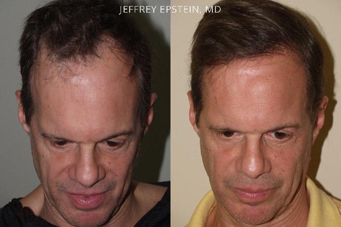 Trasplante de Pelo en Hombres Antes y después en Miami, FL, Paciente 77296
