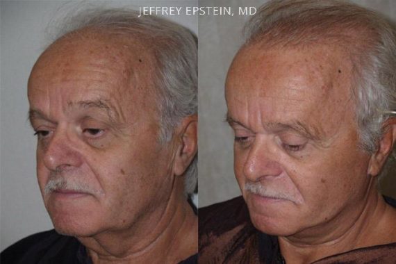Trasplante de Pelo en Hombres Before and after in Miami, FL, Paciente 77275