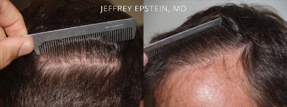 Hair Transplants for Men Before and after in Miami, FL, Paciente 39853