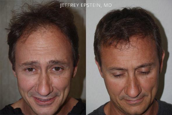 Hair Transplants for Men Before and after in Miami, FL, Paciente 39853