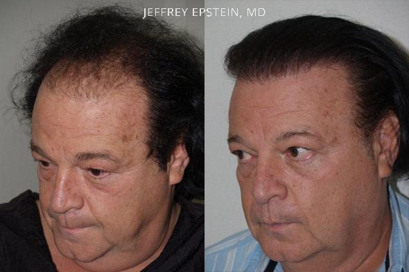 Hair Transplants for Men Before and after in Miami, FL, Paciente 39860