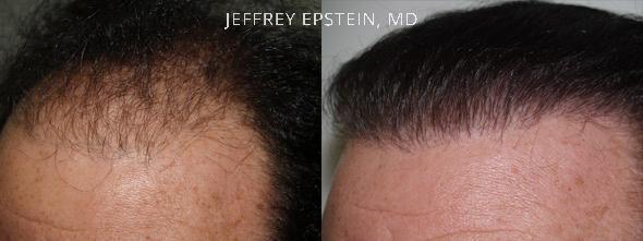Hair Transplants for Men Before and after in Miami, FL, Paciente 39860