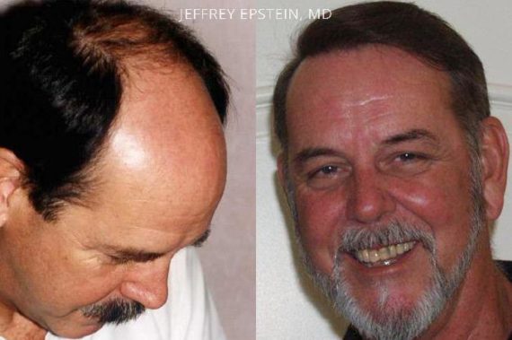 Trasplante de Pelo en Hombres Before and after in Miami, FL, Paciente 77181
