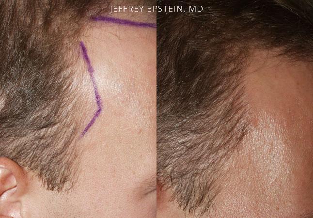 Hair Transplants for Men Before and after in Miami, FL, Paciente 39875