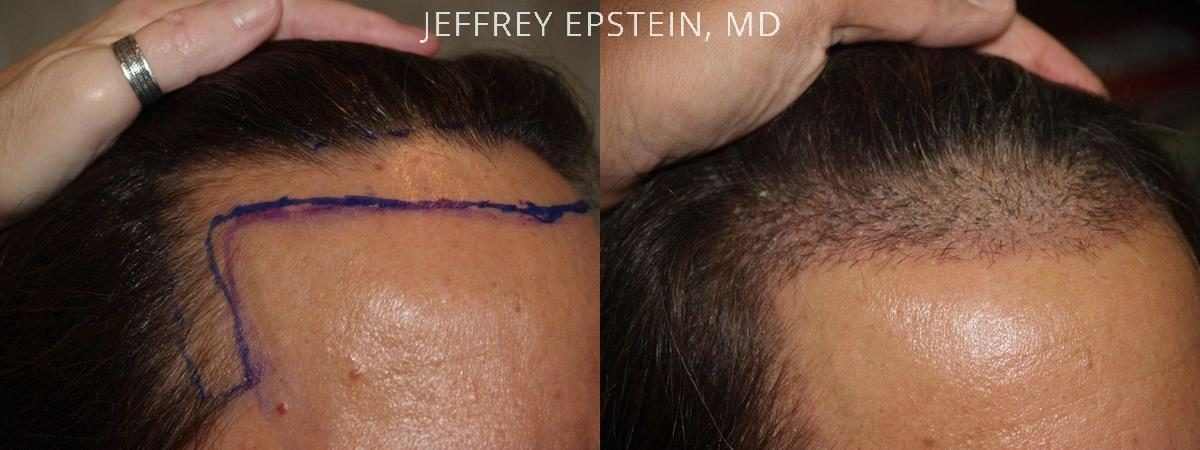 Hair Transplants for Men Before and after in Miami, FL, Paciente 39882