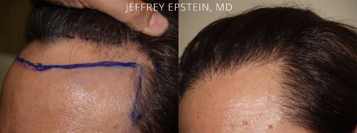 Hair Transplants for Men Before and after in Miami, FL, Paciente 39882