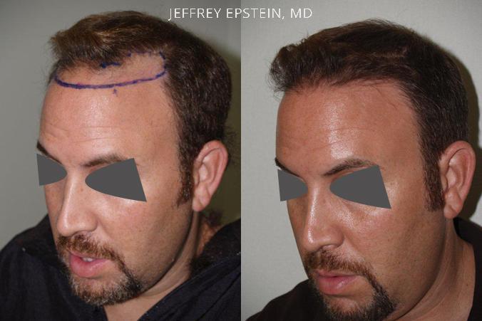 Hair Transplants for Men Before and after in Miami, FL, Paciente 39893