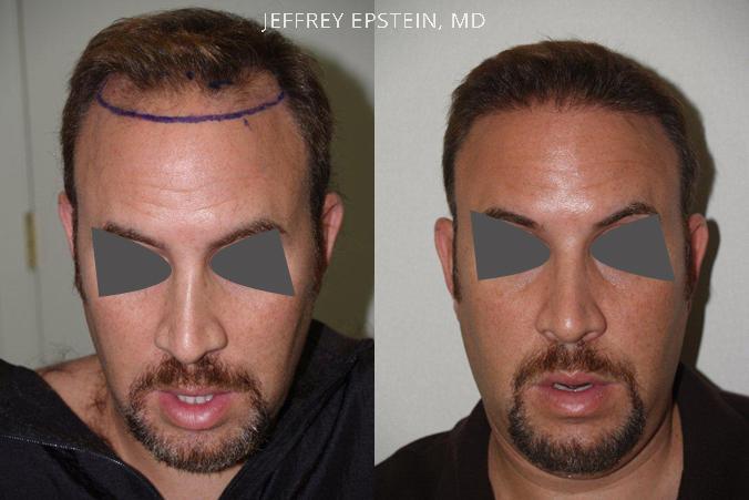 Hair Transplants for Men Before and after in Miami, FL, Paciente 39893