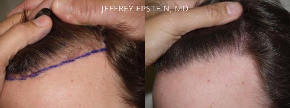 Hair Transplants for Men Before and after in Miami, FL, Paciente 39898