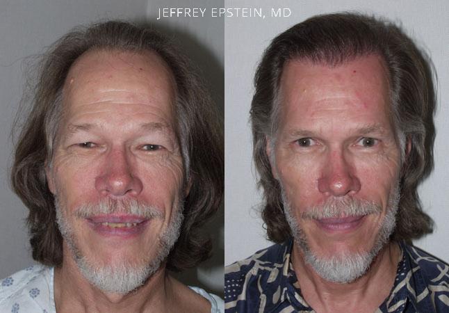 Hair Transplants for Men Before and after in Miami, FL, Paciente 39905
