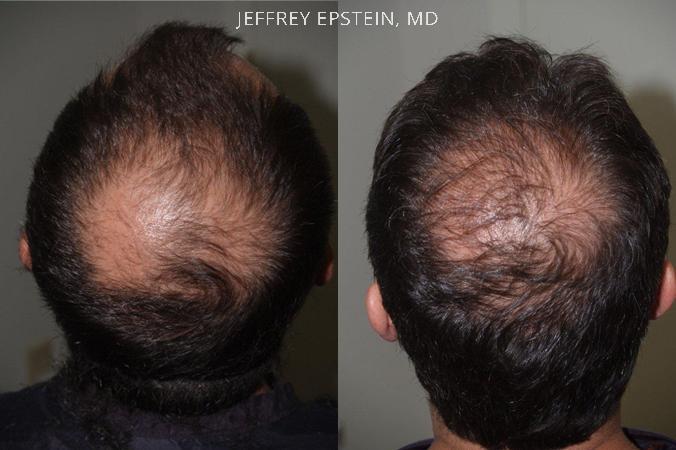Hair Transplants for Men Before and after in Miami, FL, Paciente 39916