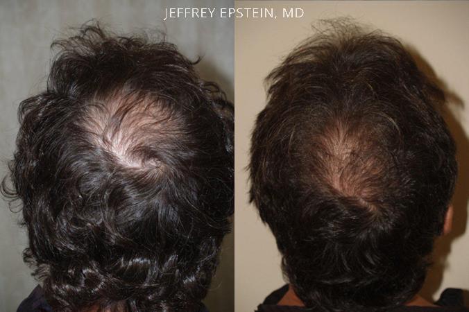 Hair Transplants for Men Before and after in Miami, FL, Paciente 39923