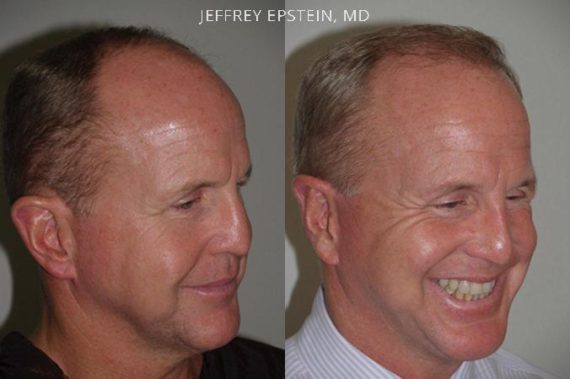Hair Transplants for Men Before and after in Miami, FL, Paciente 39931
