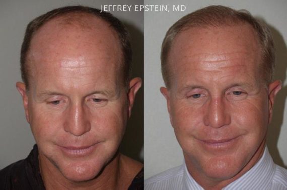 Trasplante de Pelo en Hombres Before and after in Miami, FL, Paciente 76873