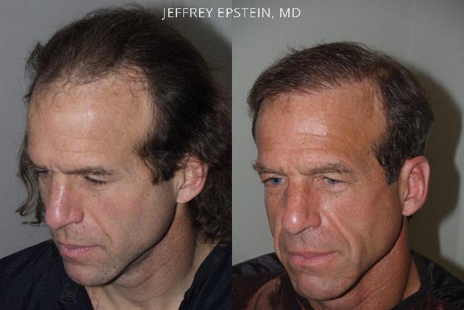 Hair Transplants for Men Before and after in Miami, FL, Paciente 39940
