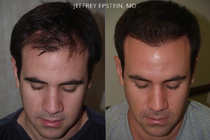 Trasplante de Pelo en Hombres Antes y después en Miami, FL, Paciente 76831