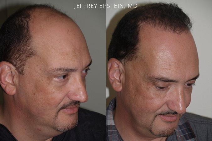 Hair Transplants for Men Before and after in Miami, FL, Paciente 39953