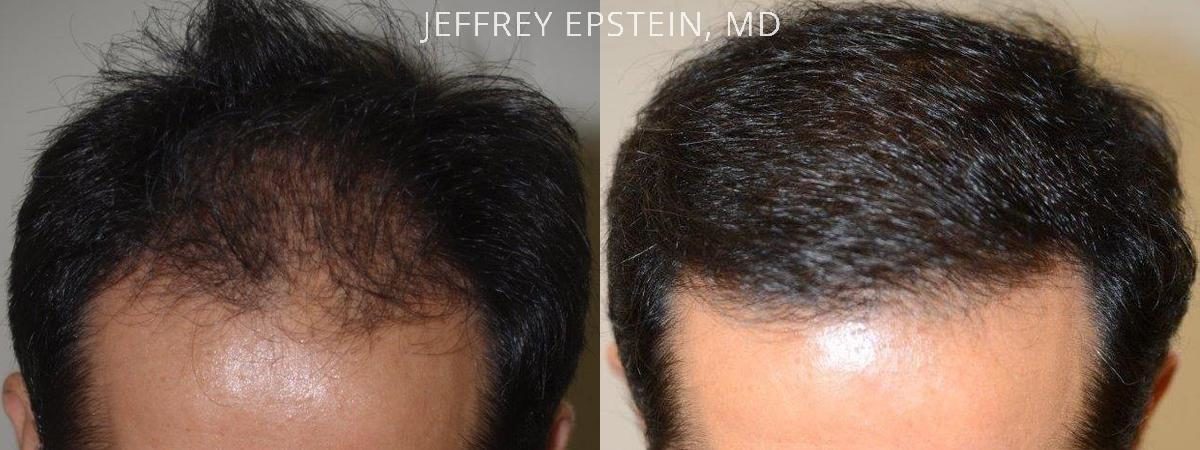 Hair Transplants for Men Before and after in Miami, FL, Paciente 39960