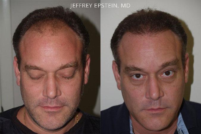 Hair Transplants for Men Before and after in Miami, FL, Paciente 39972