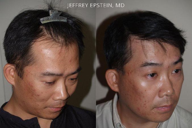 Hair Transplants for Men Before and after in Miami, FL, Paciente 39980
