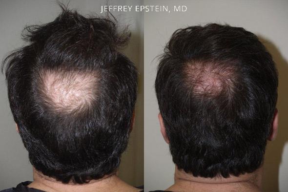 Hair Transplants for Men Before and after in Miami, FL, Paciente 39997