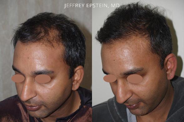 Hair Transplants for Men Before and after in Miami, FL, Paciente 40000