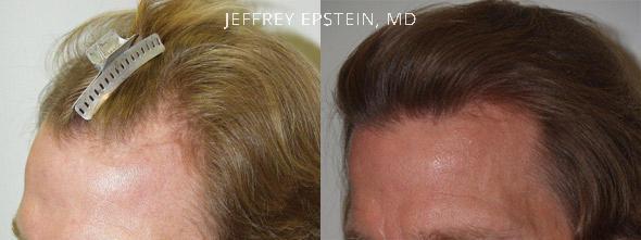 Hair Transplants for Men Before and after in Miami, FL, Paciente 40007