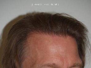 Hair Transplants for Men Before and after in Miami, FL, Paciente 40007