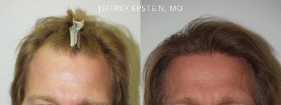 Trasplante de Pelo en Hombres Before and after in Miami, FL, Paciente 76554