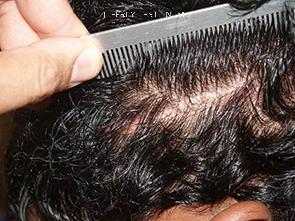 Hair Transplants for Men Before and after in Miami, FL, Paciente 40025