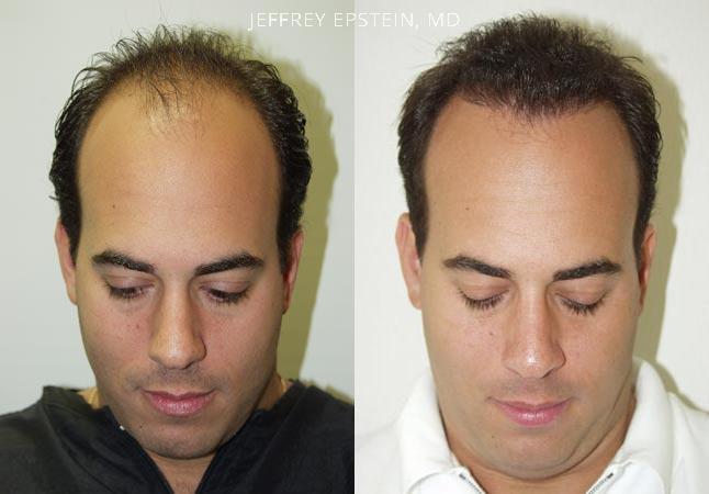 Hair Transplants for Men Before and after in Miami, FL, Paciente 40031