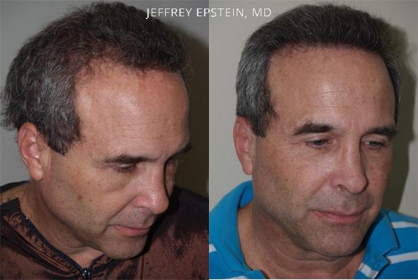 Hair Transplants for Men Before and after in Miami, FL, Paciente 40036