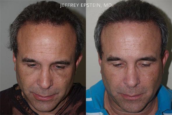 Hair Transplants for Men Before and after in Miami, FL, Paciente 40036
