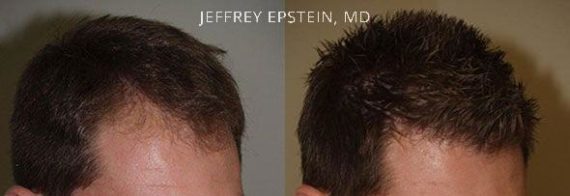 Hair Transplants for Men Before and after in Miami, FL, Paciente 40045