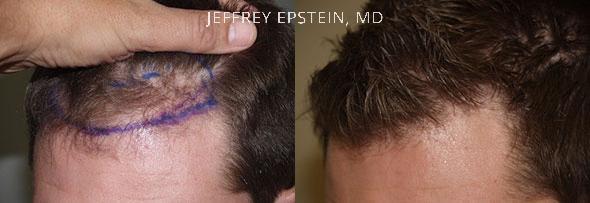 Hair Transplants for Men Before and after in Miami, FL, Paciente 40045