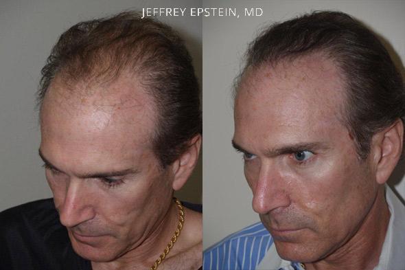 Trasplante de Pelo en Hombres Antes y después en Miami, FL, Paciente 76364