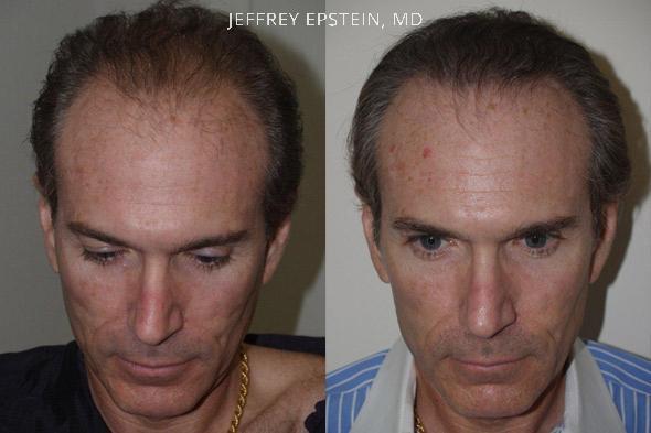 Hair Transplants for Men Before and after in Miami, FL, Paciente 40052