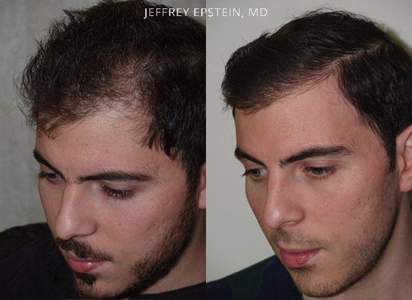 Hair Transplants for Men Before and after in Miami, FL, Paciente 40068
