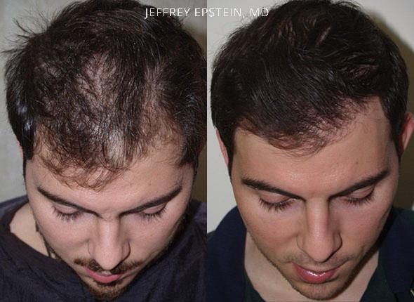 Hair Transplants for Men Before and after in Miami, FL, Paciente 40068